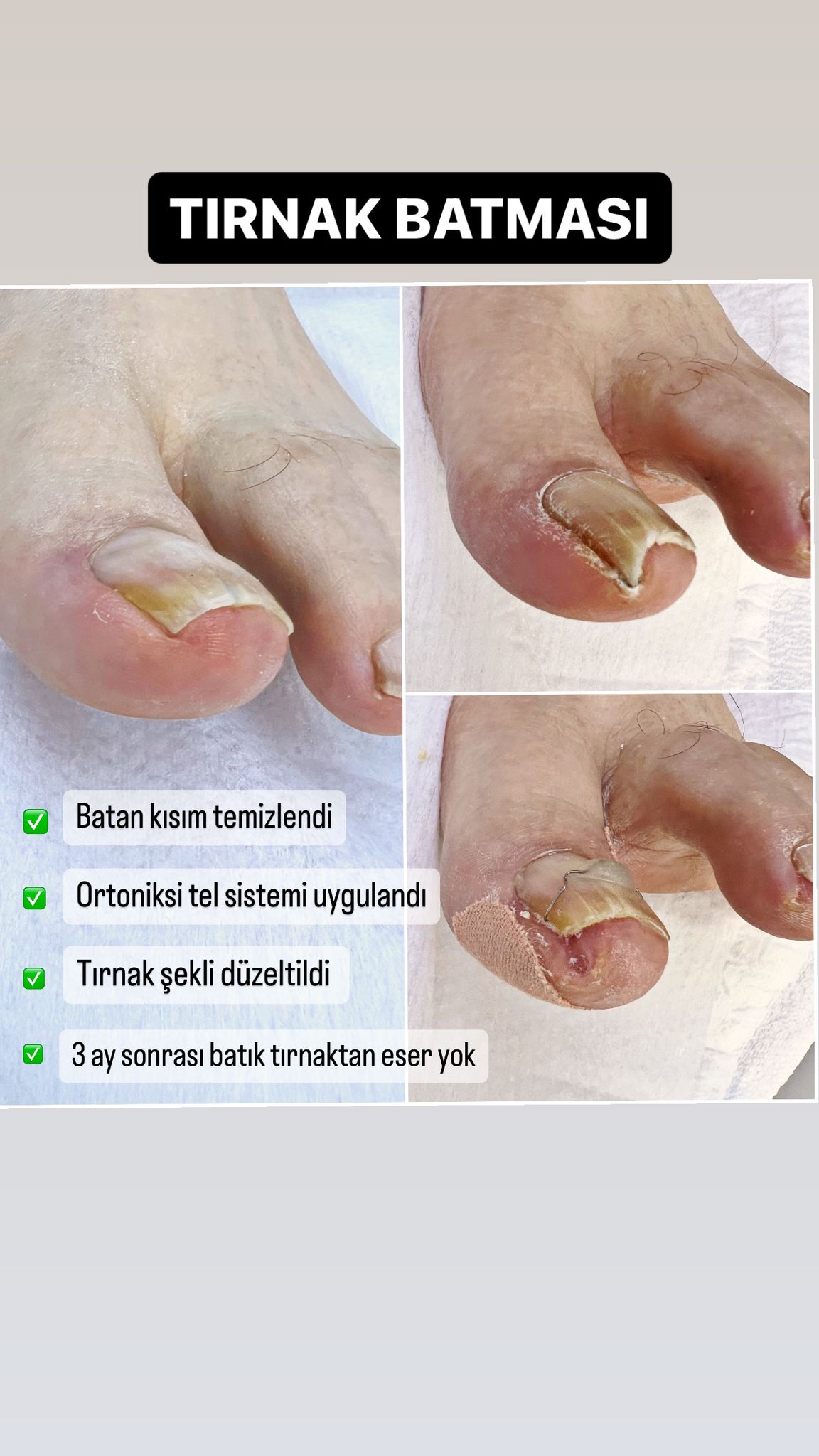 tırnak batması , medikal ayak bakımı , batık tırnak