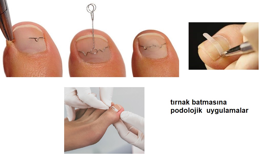 Bat�k t�rnak ,t�rnak batmas�,bat�k t�rnak nas�l ge�er